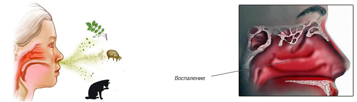 Ринит Ринит