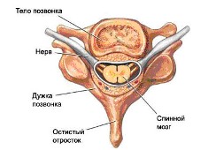 Сколиоз Сколиоз