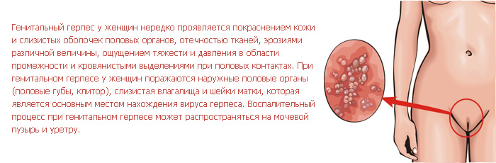 Генитальный герпес Генитальный герпес