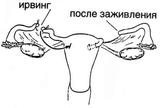 Добровольная хирургическая стерилизация у женщин